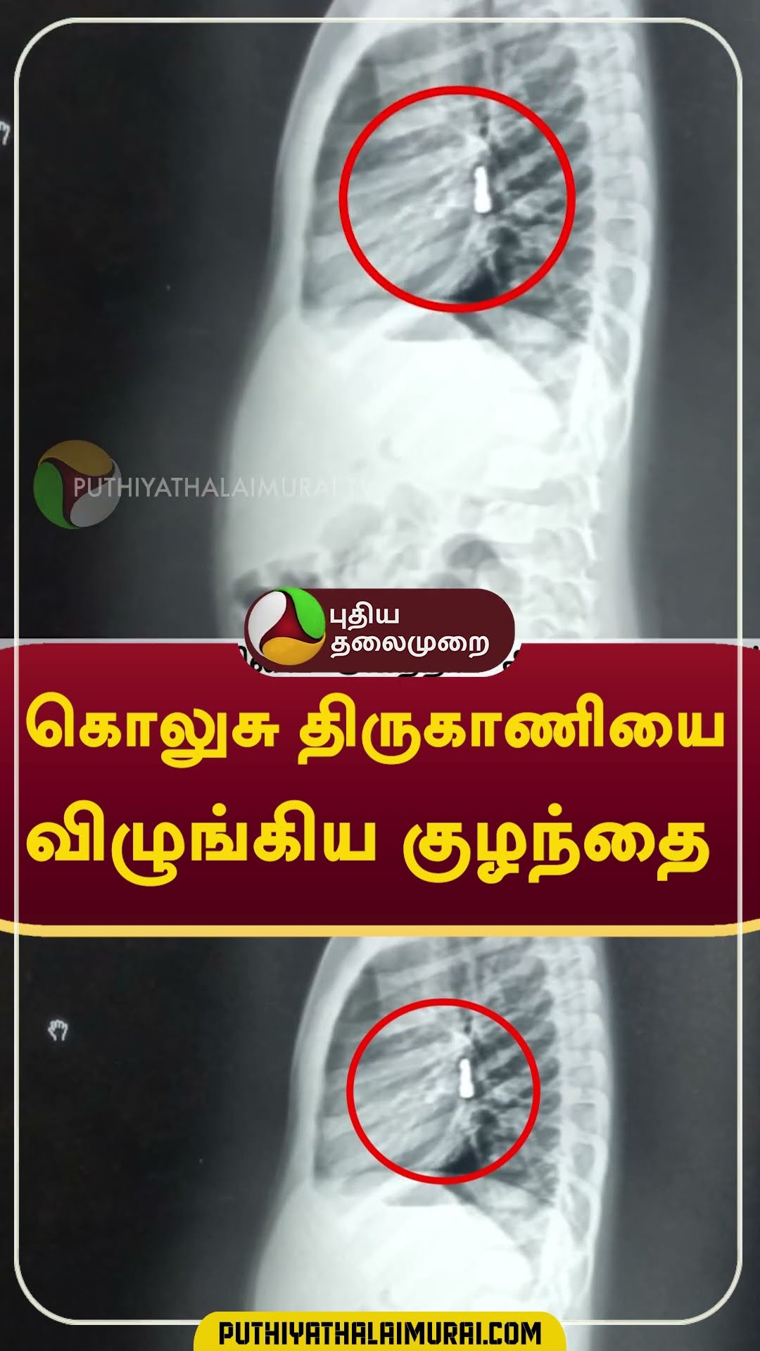 கொலுசு திருகாணியை விழுங்கிய குழந்தை #shorts