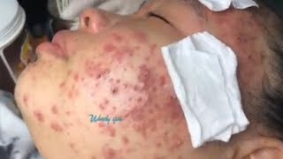 رؤوس سوداء كبيرة في الوجه ، deep clean skin face