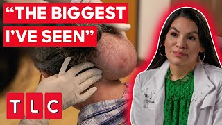 Patient Desperately Wants To Remove A MASSIVE Lipoma On His Neck | Bad Hair Day