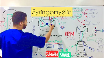 Comment soigner une cavité Syringomyélique ?