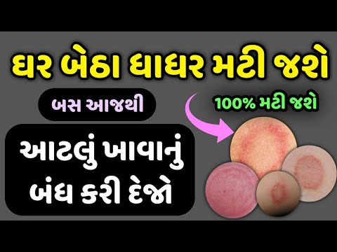 ઘર બેઠા ધાધર મટી જશે બસ આજથી આટલું ખાવાનું બંધ કરી દેજો || Veidak vidyaa || 1 ||