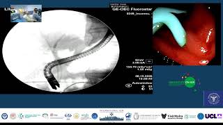 ERCP for begnin CBD stricture