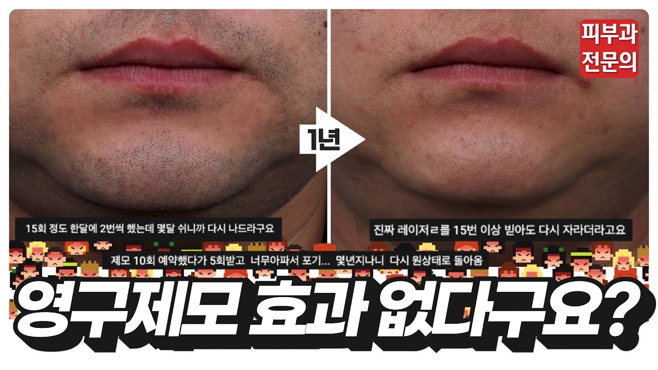 남자수염영구제모 피부과 레이저 시술의 2