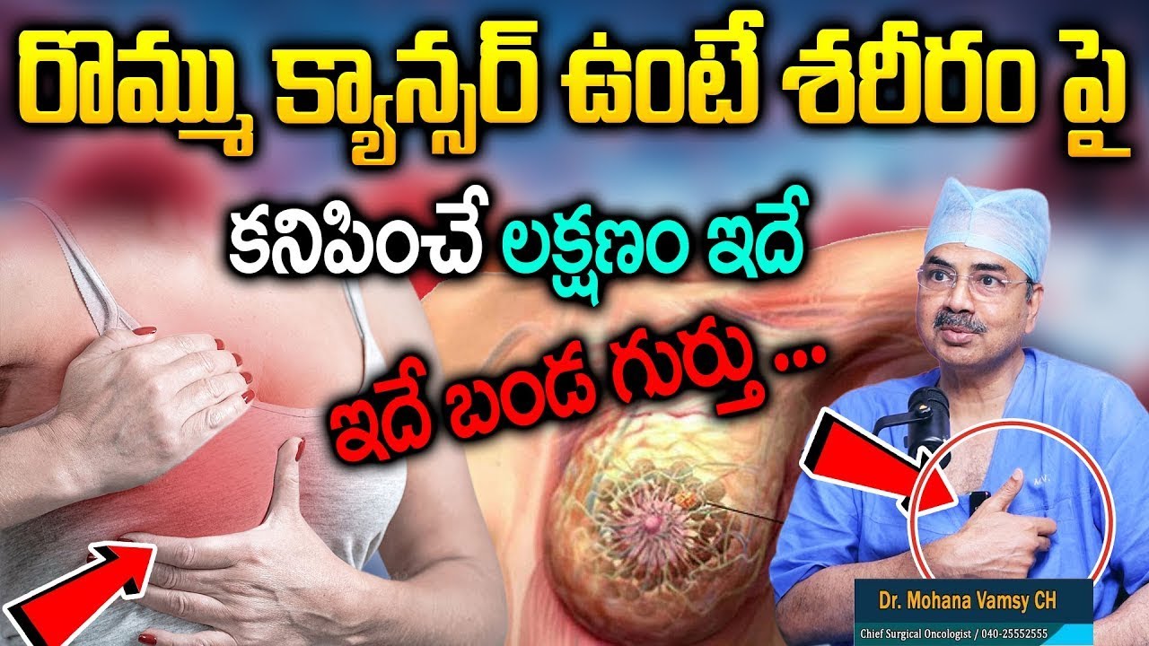 రొమ్ము కాన్సర్ లక్షణాలు || Breast Cancer || Dr.Mohan Vamsi About Cancer || Sumantv Health Care