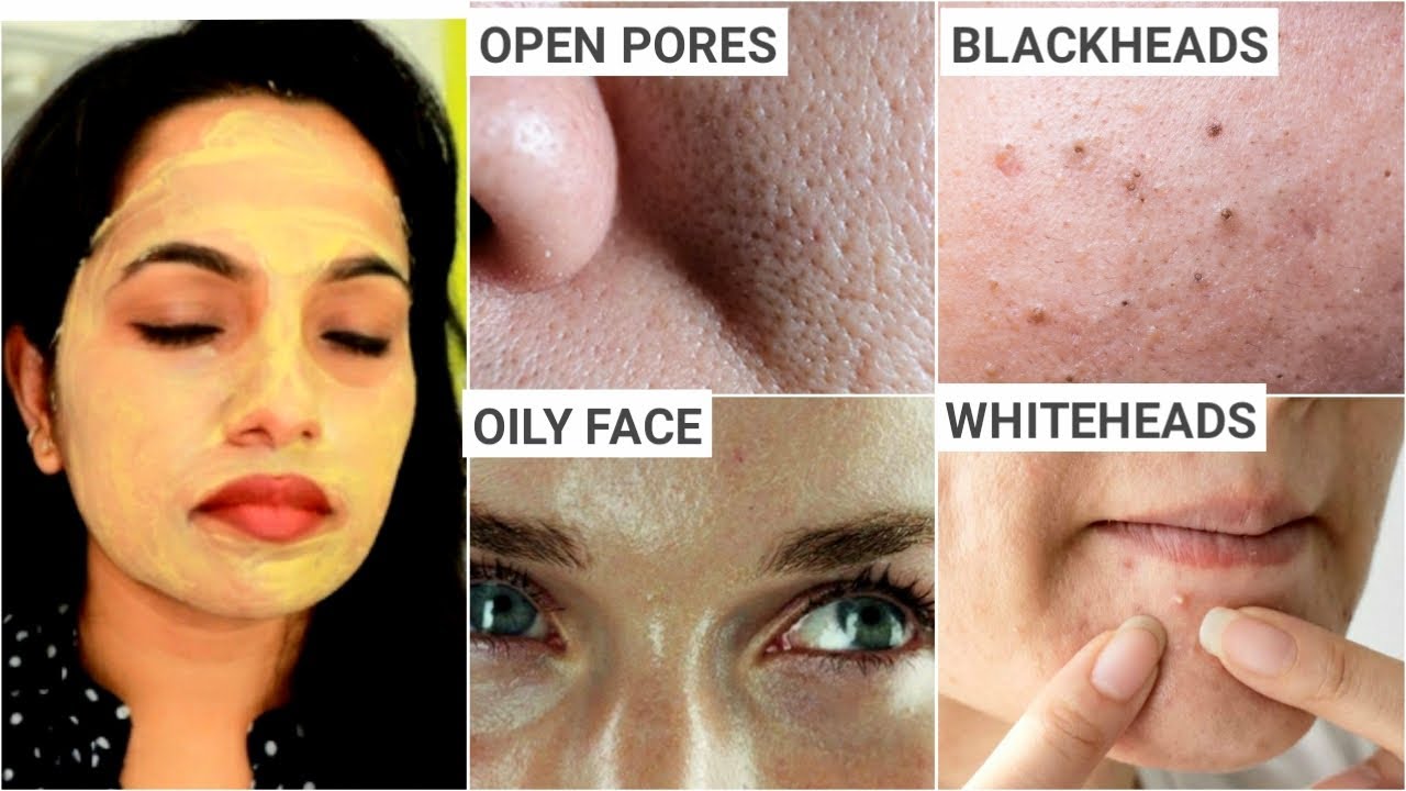 ಎಷ್ಟೇ ಹಳೆಯ OPEN PORES, LARGE PORES, CLOGGED PORES ಇದ್ದರು 100 ಹೋಗತ್ತೆ Oily Skin BLACKHEADS