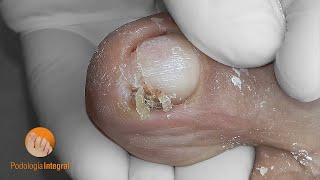 Ingrown toenail | Onychocryptosis [Podología Integral]