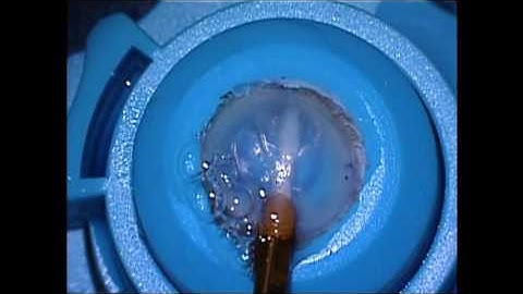 WOC2016 Video: DMEK Made Easier with an Injection