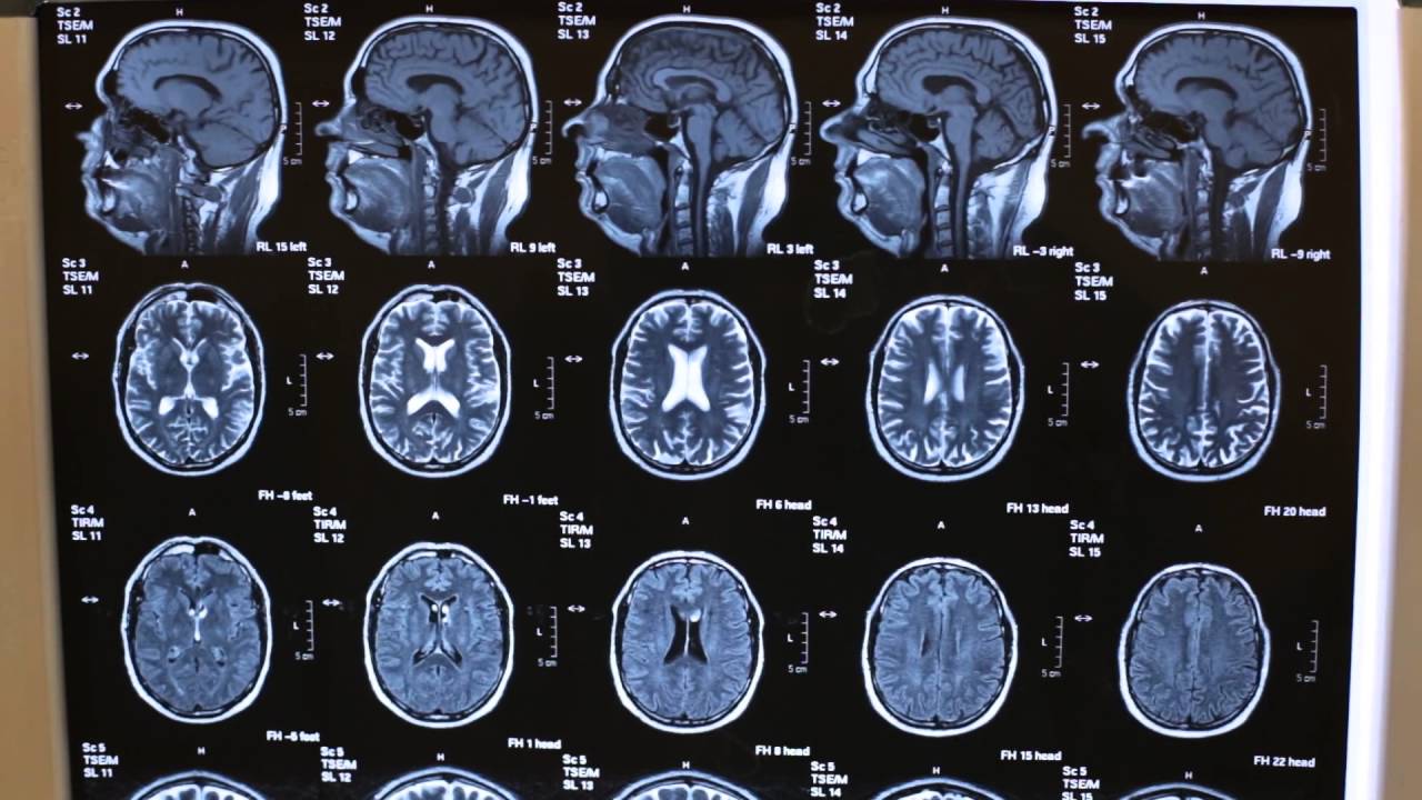 Мрт мозга ульяновске цены. Мрт мозга. Снимок мрт головы здорового человека. Снимки мрт головы здорового человека. Мрт мозга в профиль.