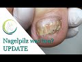 Nagelpilz was tun?  UPDATE