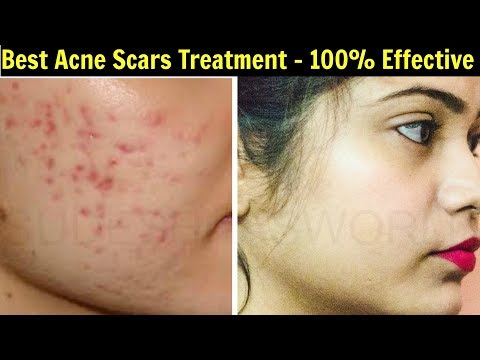 Skin Care : How to Get Rid of Acne Scars Fast Within  Days | Best Acne Scars Treatment