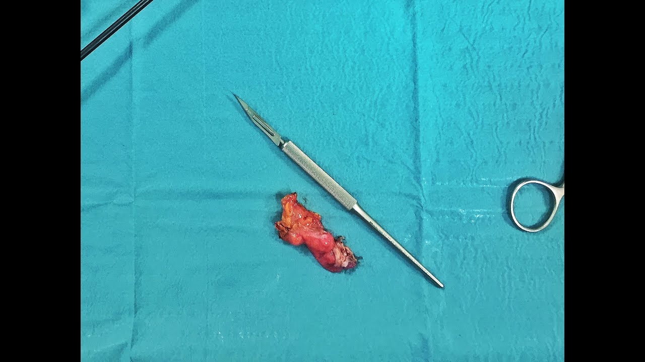 Торакоскопическое удаление кисты перикарда