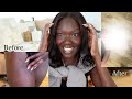 Vlog: Stretch Mark Removal on Dark Skin