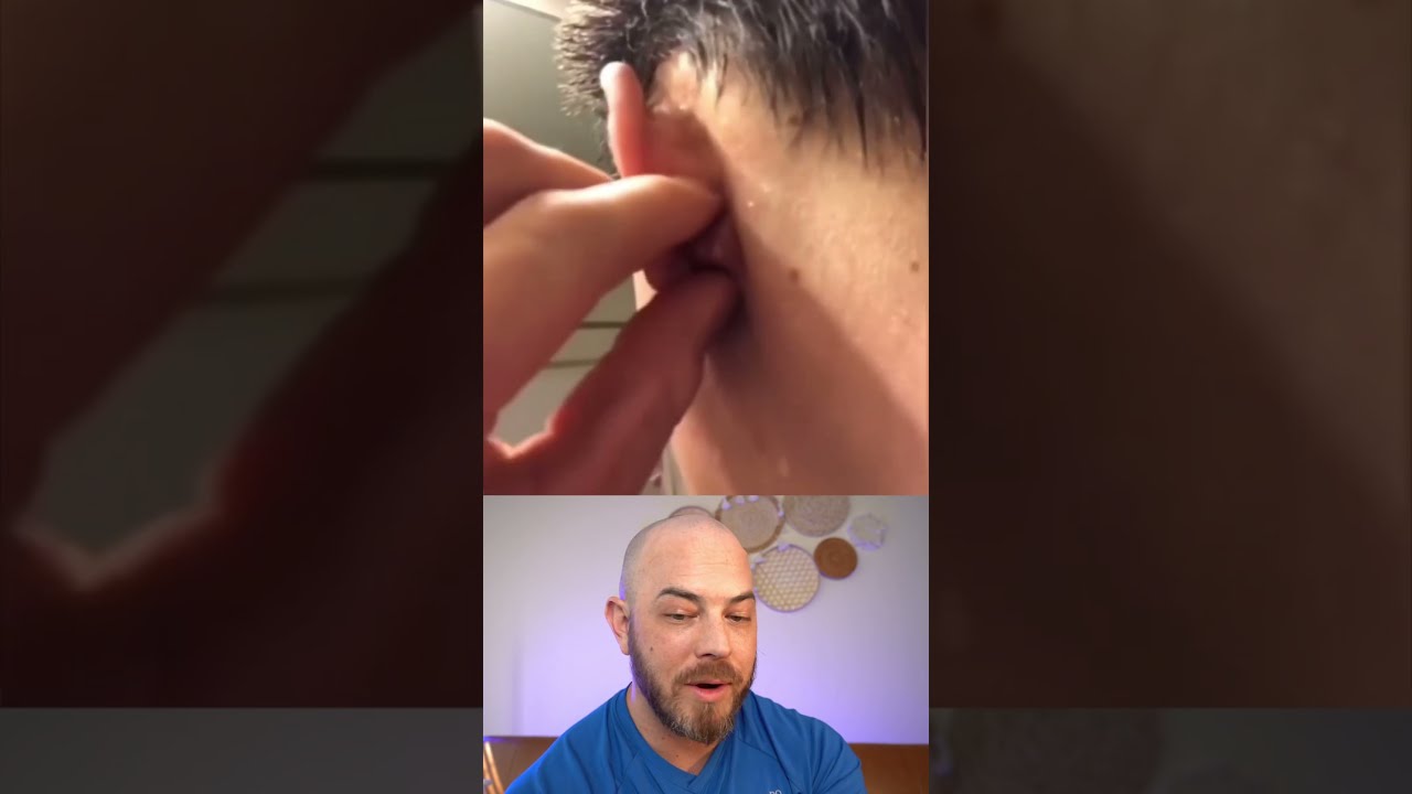 Derm Reacts To INSANE Pimple Pop Dermreacts Doctorreacts Pimplepopper
