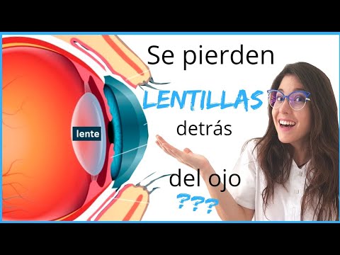 Se PIERDEN las LENTILLAS detrás del ojo ? || centro óptico LAS ARTES