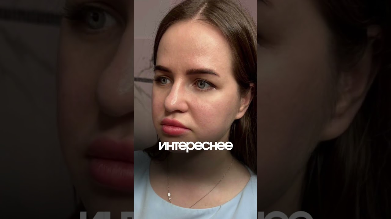 Последствия филлеров на моем лице спустя 10 лет. Часть 3 #косметолог #косметологияспб #филлеры