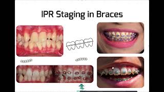 IPR Staging in Braces