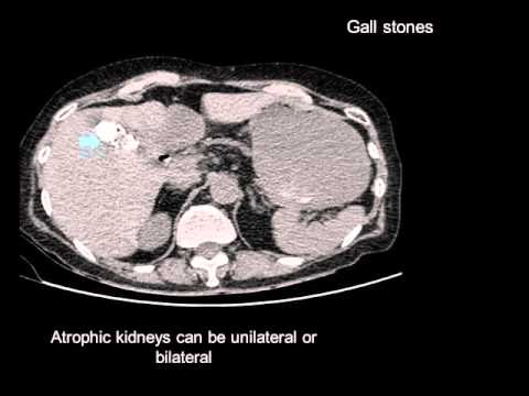 11 Incidental findings in SPECT CT