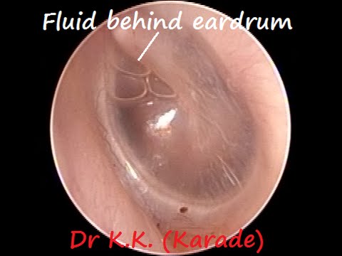 Oto-endoscopy : Fluid behind the Ear drum / Middle Ear Effusion / Glue