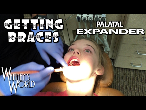 Whitney is getting Braces! | Step 2 Palatal Expander