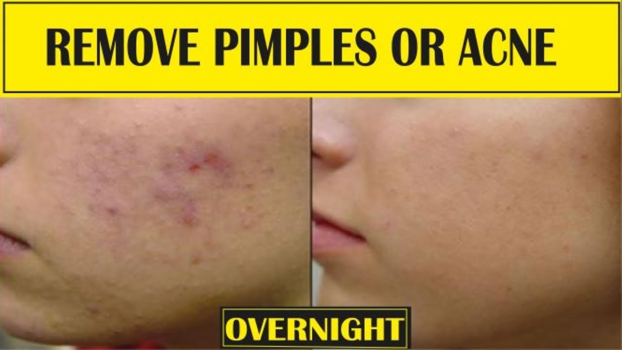 How To Remove Pimples How To Treat Pimples How To Get Rid Of Acne