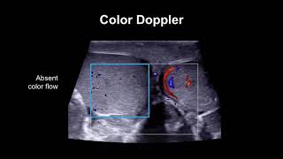 Diagnosing testicular torsion