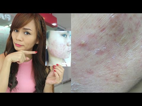 For ACNE SCARS : Flawless Easy Peel (Tagalog Review)