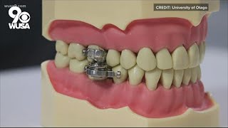 'World's first' weight loss dental device locks mouth shut, forcing a liquid diet