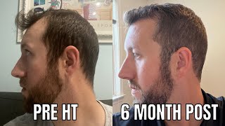 Day 181 - 6 Month Results - Fue Hair Transplant Progress Update - And It’s Still Growing!