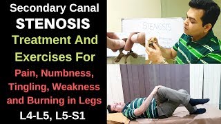 Spinal stenosis L4L5,L5S1, Foraminal stenosis, Spinal Stenosis treatment, spine stenosis exercises