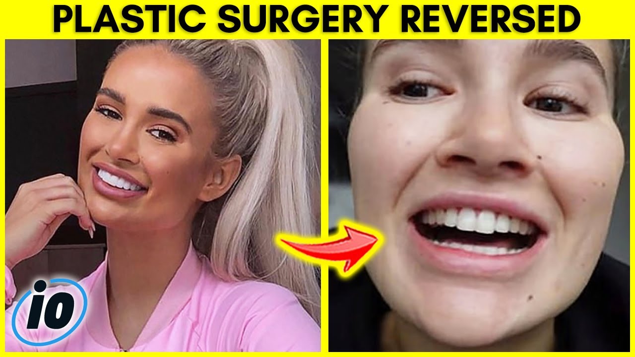 Top 5 Influencers That Reversed Their Plastic Surgery