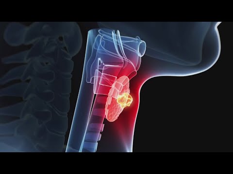 Video: 3 formas de tratar el tinnitus