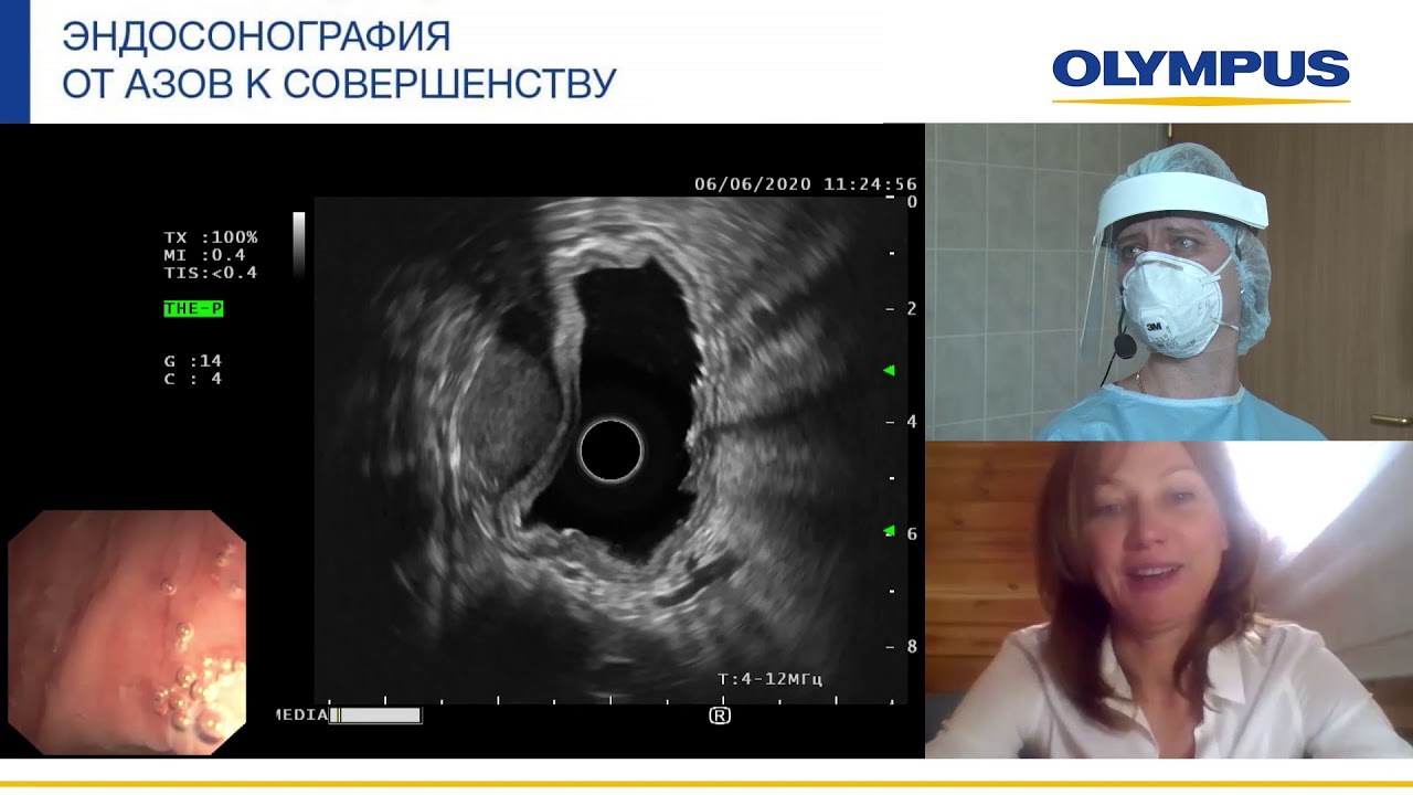 Диагностическая эндосонография неэпителиального образования стенки ...