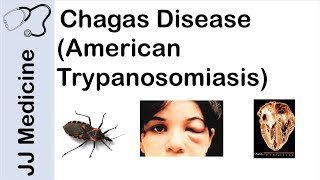 Chagas Disease | American Trypanosomiasis | Causes, Symptoms and Treatment