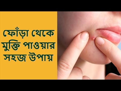 ভিডিও: তাজা ফোঁড়া কতক্ষণ স্থায়ী হয়?