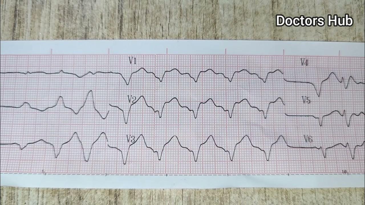 sine-wave-hyperkalemia-on-ecg-youtube