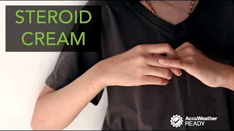 Best home remedies to relieve itchy mosquito bites