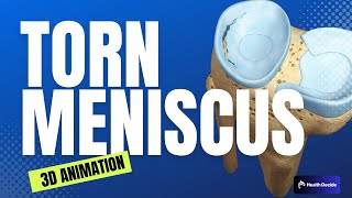 Meniscus Tears - Condition, Treatment, and Surgery - 3D Animation