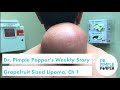 Dr. Pimple Popper's Weekly Story: Grapefruit Sized Lipoma, Chapter 1