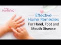 8 Effective  Home Remedies for Hand, Foot, and Mouth Disease in Children