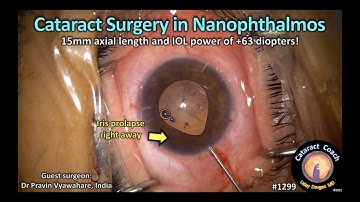 CataractCoach 1299: cataract surgery in nanophthalmos (15 mm axial length)
