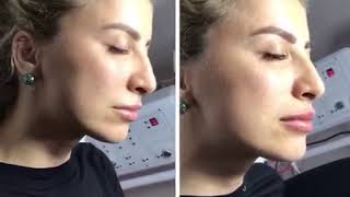 Dudak Dolgusu Botoks - Este Hilton Esthetical