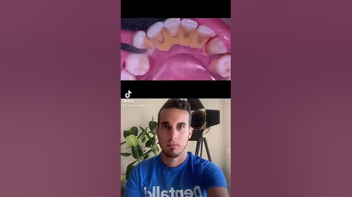 ✅CÓMO QUITAR el SARRO dental en el DENTISTA😷 - Tratamiento rápido y sencillo #shorts