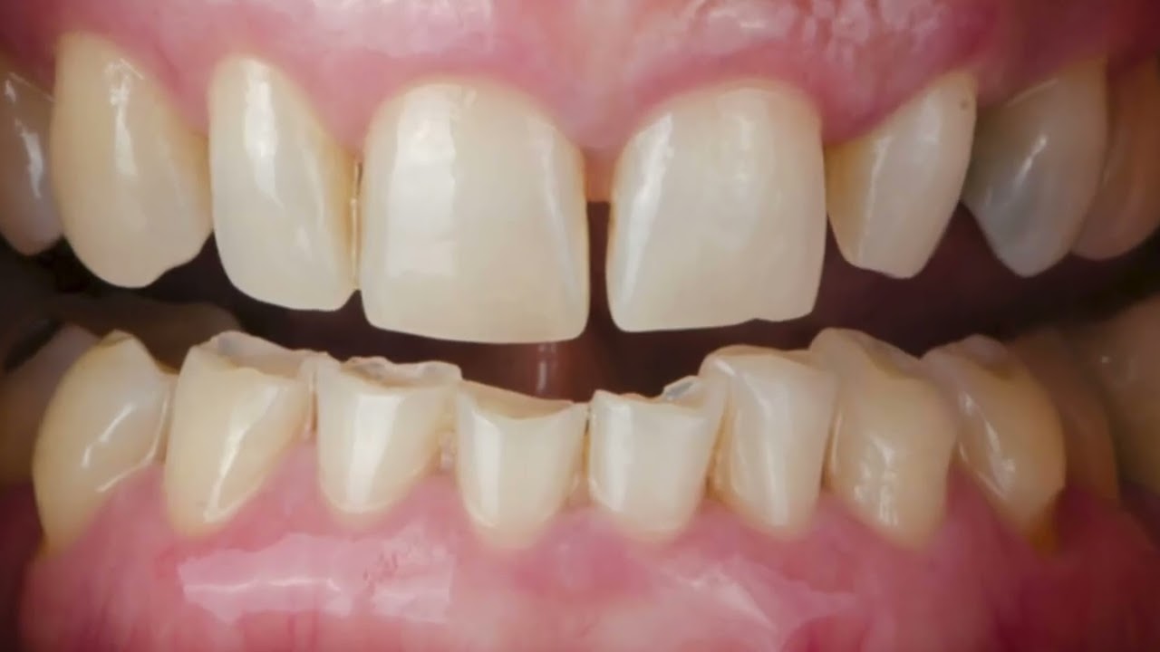 Tooth Mobility Causes & Treatment.