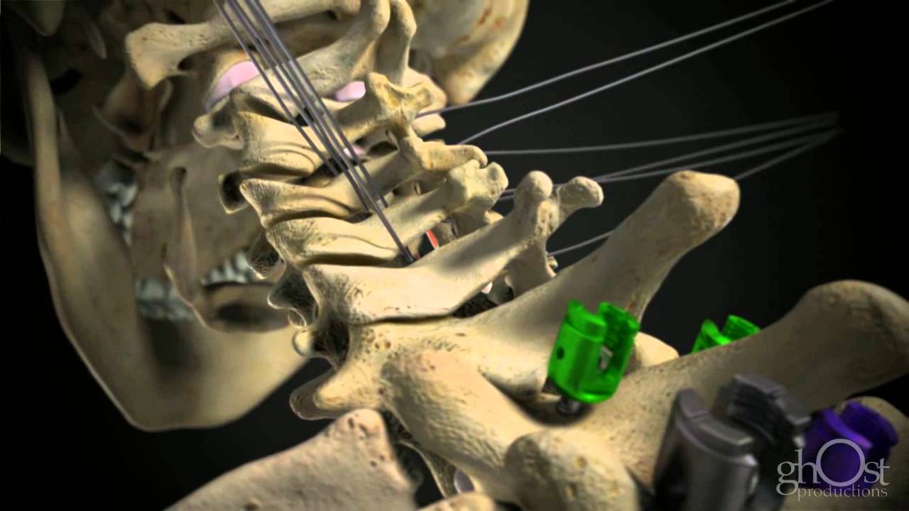 Ghost Productions DePuy Spine Cervical YouTube