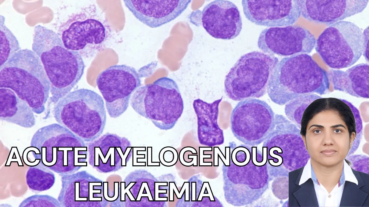 Acute Myelogenous Leukemia (AML): FAB, WHO & Auer Rods Explained ...