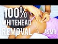 ASMR NITPICKING AND WHITE HEAD REMOVAL NO TALKING