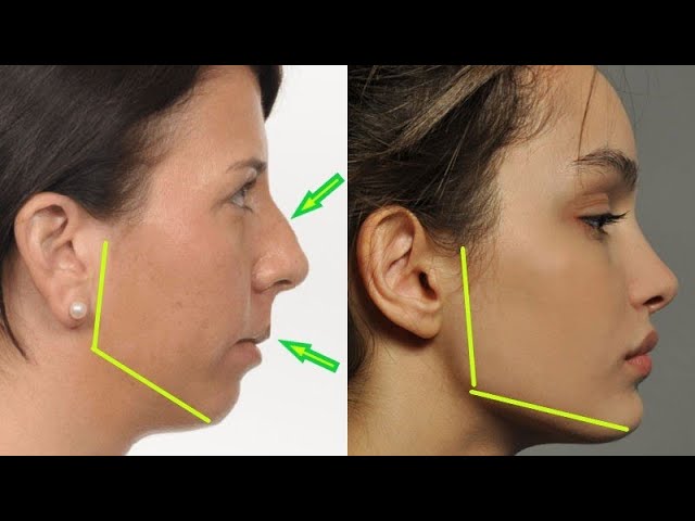 Nose breathing for children using MYOTAPE 