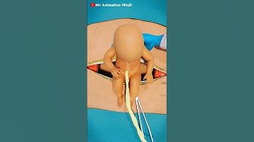 C-Section (Cesarean Delivery) Surgery - 3D Animation #medical #animation
