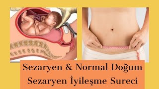 Download lagu Sezaryen Doğum iyileşme süreci Sezaryen Doğum iyileşme süreci