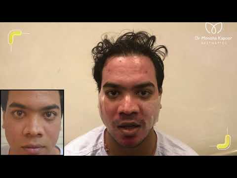 Dermabrasion Skin Treatment | Acne Scar Treatment in Delhi, India